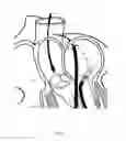 Fig. 07 - Implant and method for improving coaptation of an atrioventricular valve