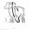 Fig. 08 - Implant and method for improving coaptation of an atrioventricular valve