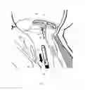 Fig. 10 - Implant and method for improving coaptation of an atrioventricular valve
