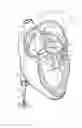 Fig. 03 - METHOD OF REPAIRING A HEART VALVE