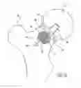 Fig. 09 - Implant Fixation Device