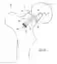 Fig. 13 - Implant Fixation Device