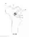 Fig. 14 - Implant Fixation Device