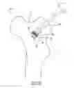 Fig. 15 - Implant Fixation Device
