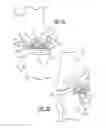 Fig. 04 - Convertible pre-partial knee replacement