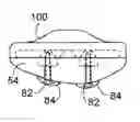 Fig. 01 - PATELLA RESURFACING PROSTHESIS