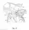 Fig. 11 - Modular reverse shoulder orthopaedic implant and method of implanting the same