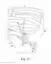 Fig. 14 - Modular reverse shoulder orthopaedic implant and method of implanting the same