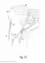 Fig. 15 - Modular reverse shoulder orthopaedic implant and method of implanting the same