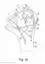 Fig. 17 - Modular reverse shoulder orthopaedic implant and method of implanting the same