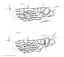 Fig. 02 - System and method for non-binding allograft subtalar joint implant
