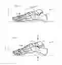 Fig. 03 - System and method for non-binding allograft subtalar joint implant