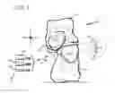 Fig. 04 - System and method for non-binding allograft subtalar joint implant