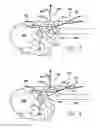 Fig. 04 - Inside-out guide for hip replacement method