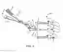 Fig. 06 - Methods and apparatus for intervertebral disc prosthesis insertion