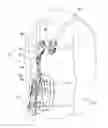 Fig. 01 - Thoracic lumbar sacral orthosis