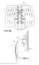 Fig. 04 - Thoracic lumbar sacral orthosis