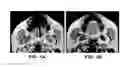 Fig. 02 - Devices And Methods For Treating Sleep Disordered Breathing