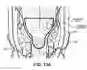 Fig. 13 - Synchronization of repetitive therapeutic interventions