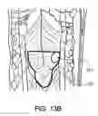 Fig. 14 - Synchronization of repetitive therapeutic interventions