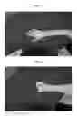 Fig. 03 - CODON-OPTIMIZED RECOMBINANT PLASMID, METHOD OF STIMULATING PERIPHERAL NERVE REGENERATION, AND METHOD OF TREATING NERVE DAMAGE IN HUMANS