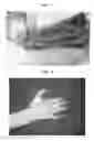 Fig. 05 - CODON-OPTIMIZED RECOMBINANT PLASMID, METHOD OF STIMULATING PERIPHERAL NERVE REGENERATION, AND METHOD OF TREATING NERVE DAMAGE IN HUMANS