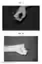 Fig. 06 - CODON-OPTIMIZED RECOMBINANT PLASMID, METHOD OF STIMULATING PERIPHERAL NERVE REGENERATION, AND METHOD OF TREATING NERVE DAMAGE IN HUMANS