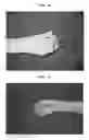 Fig. 07 - CODON-OPTIMIZED RECOMBINANT PLASMID, METHOD OF STIMULATING PERIPHERAL NERVE REGENERATION, AND METHOD OF TREATING NERVE DAMAGE IN HUMANS