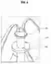 Fig. 05 - SYRINGE AND SAFETY CAP ASSEMBLY FOR SYRINGE