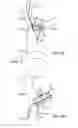 Fig. 07 - SYSTEMS AND METHODS FOR NEUROMODULATION OF SYMPATHETIC AND PARASYMPATHETIC CARDIAC NERVES