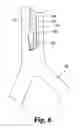 Fig. 05 - Catheters and systems useful for delivery of material to the lung