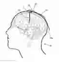 Fig. 01 - SYSTEM AND METHOD FOR DRAINING CEREBROSPINAL FLUID