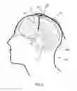 Fig. 03 - SYSTEM AND METHOD FOR DRAINING CEREBROSPINAL FLUID