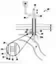 Fig. 01 - Vacuum assisted percutaneous appliance