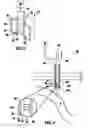 Fig. 02 - Vacuum assisted percutaneous appliance
