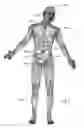 Fig. 02 - Surrogate implanted medical device for energy dissipation of existing implanted leads during MRI scans