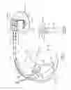 Fig. 05 - Surrogate implanted medical device for energy dissipation of existing implanted leads during MRI scans