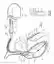 Fig. 08 - Surrogate implanted medical device for energy dissipation of existing implanted leads during MRI scans
