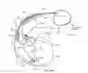Fig. 16 - Surrogate implanted medical device for energy dissipation of existing implanted leads during MRI scans