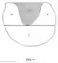 Fig. 05 - Radiation method and apparatus for radiating a fluence map having zero fluence region