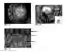 Fig. 02 - Animal models of corneal angiogenesis and corneal ectatic diseases, methods of producing, and methods of use thereof
