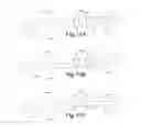 Fig. 12 - Devices, systems, and methods for removing targeted lesions from vessels