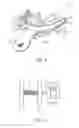 Fig. 03 - Bite tray having fiducial markers for head scan registration and method of use