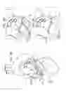 Fig. 13 - LEFT ATRIAL APPENDAGE CLOSURE