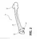 Fig. 03 - Devices and methods for knee arthroplasty