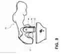 Fig. 04 - Devices and methods for knee arthroplasty