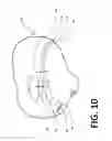 Fig. 11 - Devices and methods for knee arthroplasty