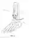 Fig. 03 - METHODS AND INSTRUMENTS FOR SUBCHONDRAL TREATMENT OF OSTEOARTHRITIS IN A SMALL JOINT