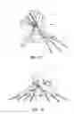 Fig. 07 - METHODS AND INSTRUMENTS FOR SUBCHONDRAL TREATMENT OF OSTEOARTHRITIS IN A SMALL JOINT