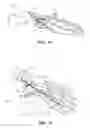 Fig. 10 - METHODS AND INSTRUMENTS FOR SUBCHONDRAL TREATMENT OF OSTEOARTHRITIS IN A SMALL JOINT